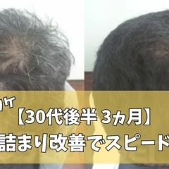 【30代男性】薄毛と大量のフケが3ヵ月スピード改善症例