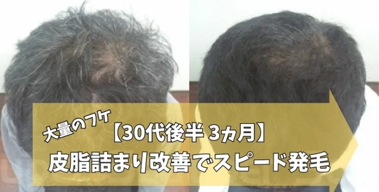 30代男性AGA薄毛改善症例「【30代男性】薄毛と大量のフケが3ヵ月スピード改善症例」
