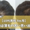 【高校生つむじの薄毛】海は苦い思い出。楽しいはずの夏休みが一転。