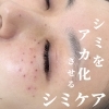 南魚沼でシミをアカ化させ排出するシミケア！