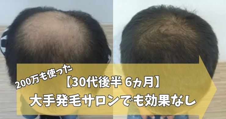 30代男性AGA薄毛改善症例「【30代男性6ヵ月】大手サロンで200万つぎ込み効果なし‼」