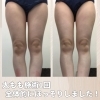 太もも一回の施術でも引き締まる！脂肪燃焼＆筋肉増加を叶える痩身スカルプト◎
