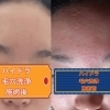 ハイドラフェイシャル始まってます。