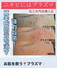 ニキビ強力殺菌「ニキビにはプラズマ！」