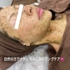 頬は何で赤くなるの？【福島市初のグリーンピール専門エステサロン/肌質改善におすすめ】