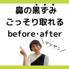 鼻の黒ずみごっそり取れる  before after