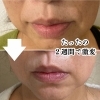 たったの２週間でこの違い！しわ、たるみ、毛穴が気になる方は試してみるべき！