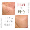 「ニキビにはハーブの力【ハーブピーリング/福井エステ/肌質改善】」
