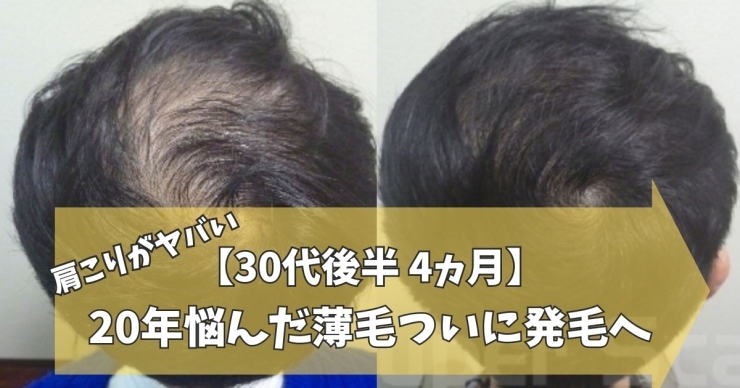 30代男性AGA薄毛改善症例「【30代男性】AGA薄毛改善4ヵ月」