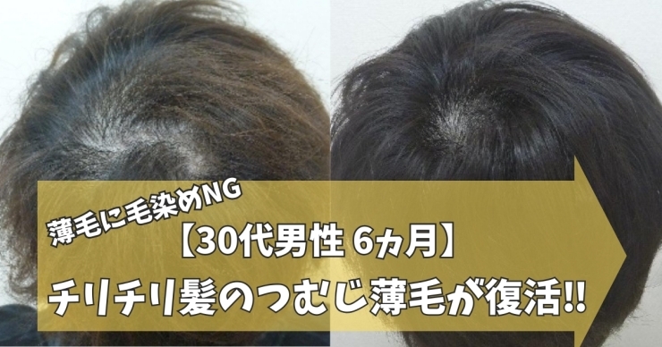 30代男性AGA薄毛改善症例「【30代男性6ヵ月】薄毛に毛染めはNG」