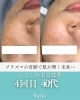 毛穴、くすみ、シミがお悩み 40代 プラズマニードル4回目