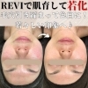 「開いた毛穴も自分力を付けて引き締め◎REVIハーブピーリングで最後の肌質改善☆」