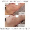 クレーターも改善できるハーブピーリング「しつこいニキビ・ニキビ跡・クレーターお任せください✨【福井エステ/福井ハーブピーリング/福井ハーブ/福井フェイシャルエステ】」