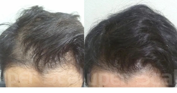 30代男性AGA薄毛改善症例「薄毛に悩む30代男性が驚異の3ヵ月スピード発毛‼」