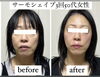 サーモシェイプ「美容鍼とサーモシェイプ！でたるみ、エラはり！小顔最強」