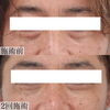 目の下ハイフ男性の方にも大人気「切らないクマ取りで若々しい目元へ【福井ハイフ/福井エステ/福井フェイシャルエステ】」