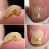 ヘイスイッチ巻き爪ケア「巻き爪ケア 葛飾区青戸 ジェルで巻き爪ケア 4日間かけて広げてその後はずっとキープ」