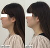 《20代女性》施術後の比較「たるみ改善しシャープなフェイスラインへ🧚‍♀️【 福井 / 福井市 / 福井エステ / エステ / フェイシャル / ハイフ / ハーブピーリング / 小顔 / たるみ改善 / 美肌 】」