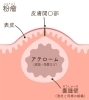 粉瘤の断面「顔や背中などにできる粉瘤は形成外科で相談しましょう」