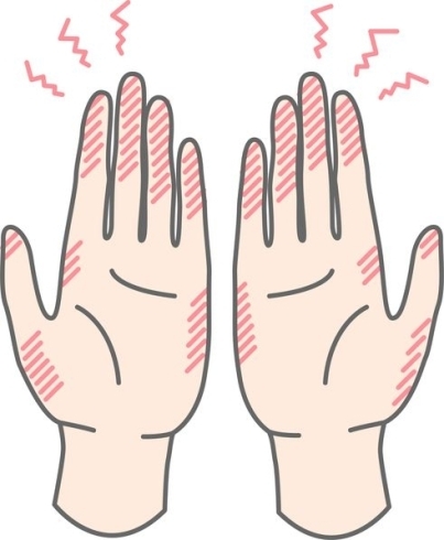 手湿疹「手湿疹のケアについて、皮膚科に勤務する看護師との対話」