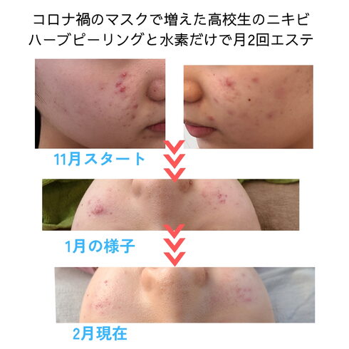皮膚科の薬を卒業しよう!「薬に頼らずともニキビは改善できます!【宮崎市フェイシャルエステ・リセル・皮膚科監修サロン・肌質改善専門・無添加・ニキビケア・シミ取り】」
