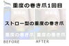 No.72ストロー重度の巻き爪施術事例１「No.72ストロー重度の巻き爪」