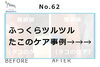 No.62たこ施術事例１「No.62たこのケア施術事例」