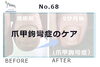 N68.変形爪（爪甲鉤彎症）のケア事例１「N68.変形爪（爪甲鉤彎症）のケア事例」