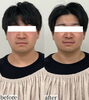 「ブライダル前にハイフでさらに素敵に💆‍♂️✨【 福井 / 福井エステ / 福井ハイフ / トリプルハイフ / 小顔 / ポレーション / 美肌 / 脂肪溶解 】」