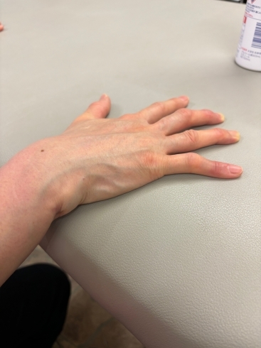 指の伸展障害「以前転倒で骨折された方がこられました。」