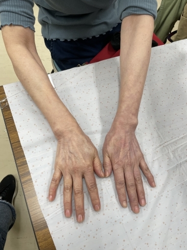 血流アップ！右手（画像左側）:施術後、左手:施術前「冷え症　ハンドトリートメント　大野城」