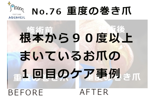 No.76　重度の巻き爪のケア１回目１「No.76　重度の巻き爪のケア１回目」