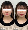 なりたいフェイスライン造れます「髪の毛で顔を隠すの終わりにします【福井ハイフ/福井小顔/福井エステ/福井フェイシャルエステ】」