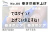 N80.巻き爪根本上げの施術事例１「N80.巻き爪根本上げの施術事例」