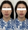 ハイフなしでもリフトアップ「妊娠中・授乳中の方もハイフなしで小顔へ【福井ハイフ/福井小顔エステ/福井フェイシャルエステ】」