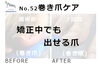 No.52巻き爪ケア「矯正中でも出せる爪」１「No.52巻き爪ケア「矯正中でも出せる爪」」