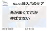 No.51陥入爪「角が痛くて爪が伸ばせない」１「No.51陥入爪「角が痛くて爪が伸ばせない」」