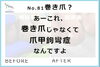 No.81あーこれ巻き爪じゃなくて爪甲鉤彎症１「No.81あーこれ巻き爪じゃなくて爪甲鉤彎症なんですよ」