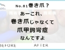 No.81あーこれ巻き爪じゃなくて爪甲鉤彎症なんですよ