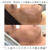 剥離なしハーブ8回＋飲む美容液毎日「"美肌になりたい男性必見"理想の肌、当店で叶います【福井ハーブピーリング/福井ハイフ/福井フェイシャルエステ】」