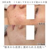 毎日鏡を見るのが楽しい肌へ「ニキビ肌から卒業し褒められる美肌へ【福井ハーブピーリング/福井フェイシャルエステ/福井ハイフ】」