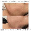 圧倒的な美肌へ「ニキビ跡・クレーター撲滅【福井ハーブピーリング/福井フェイシャルエステ/福井ハイフ】」