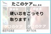 たこのケア事例No.84写真１「【硬い芯をごっそり取ります！たこのケア事例No.84】」