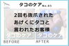 たこのケア事例No.85-1「もう指はいらないとさえ思った。たこのケア事例No.85」