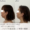 フェイスラインの骨くっきり「切らずにフェイスライン若返り【福井ハイフ/二重顎改善/福井小顔】」
