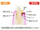 歯周病・虫歯にならない為には、歯と歯ぐきのブラッシングを。 
