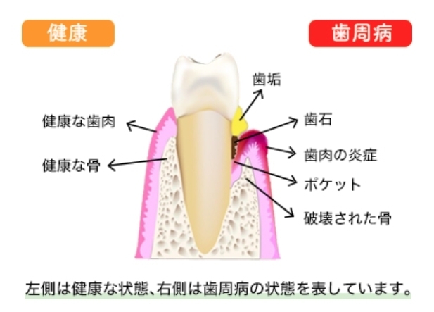 出典 : 日本臨床歯周病学会Hp「歯周病・虫歯にならない為には、歯と歯ぐきのブラッシングを。 」