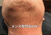 ヒゲ脱毛2回目「2回目ヒゲ脱毛効果」