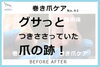 グサッとつきささっていた爪の跡1「グサッとつきささっていた爪の跡が！　巻き爪ケア事例No.93」