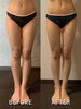 脂肪冷却4カップ「4カップで激変！！#福山脚やせ#福山ダイエット#ダイエット#福山痩せたい#ダイエット中#福山脚やせエステ#エステサロン#福山エステ#福山ダイエットサプリ#福山脂肪冷却#脂肪冷却#福山ダイエット食」